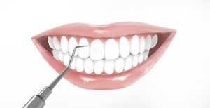 Professionelle Zahnreinigung, Zahnpflege