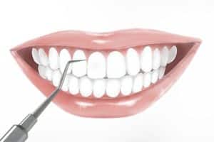 Professionelle Zahnreinigung weißere Zähne | Erfahrung, Ablauf, Kosten