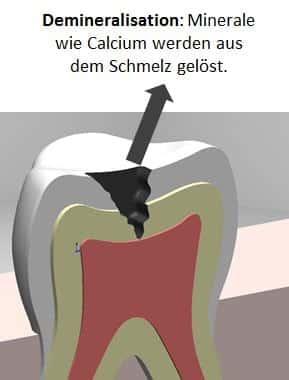 Demineralisation, Karies