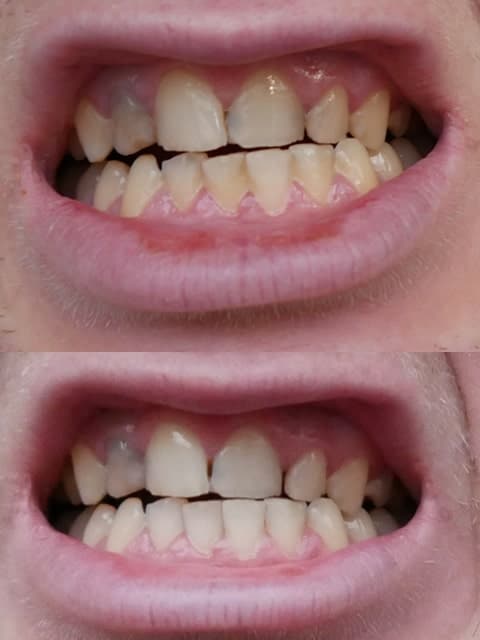 Weißere zähne durch die professionelle Zahnreinigung, professionelle Zahnreinigung vorher nachher