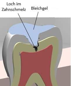 Bleichgel dringt in denn Zahn ein