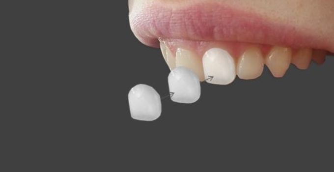 Veneers
