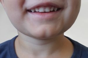 Zahnfehlstellung: Schiefe Zähne durch falsche Ernährung