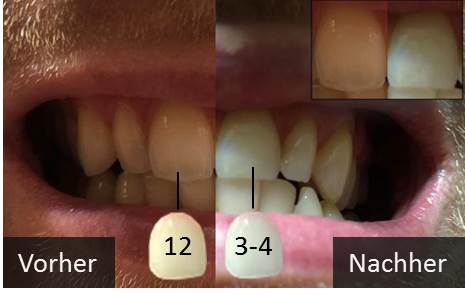 Zähne nach der Zahnaufhellung, Aktivkohle Test