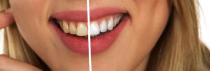 Ab welchem Alter kann man Zähne bleichen?